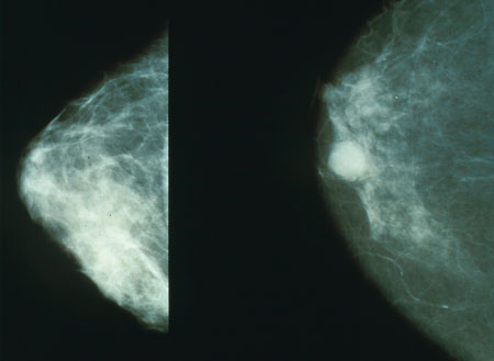 mammo_breast_cancer