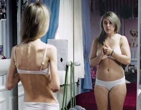 anorexia.jpeg